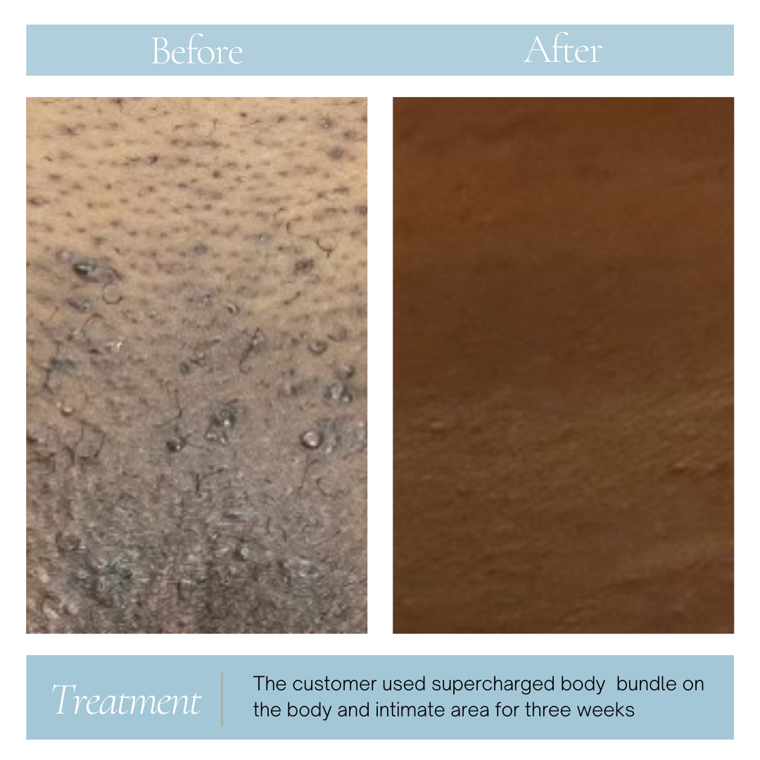 Texas Whiskey - Ingrown & Pigment serum