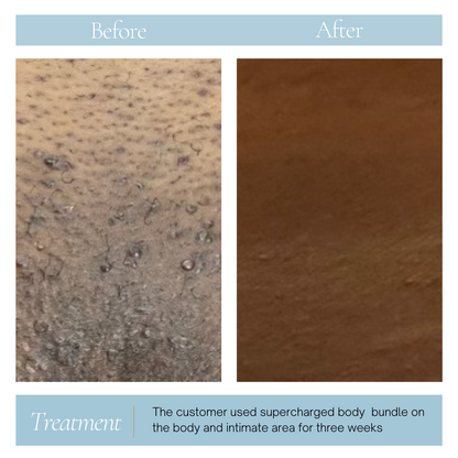 Texas Whiskey - Ingrown & Pigment serum